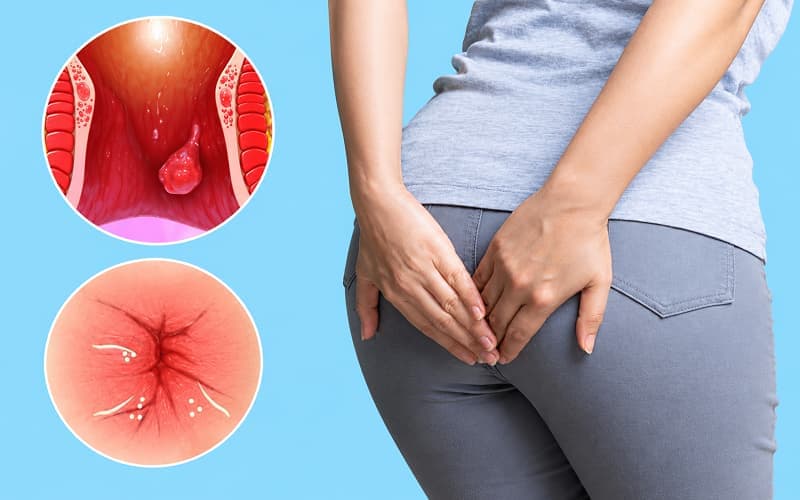Viêm ống hậu môn gây đau rát, khó chịu cho người bệnh