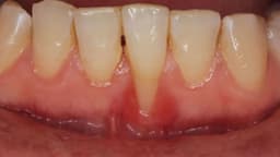 Tụt lợi là gì? Điều trị và phòng ngừa như thế nào?