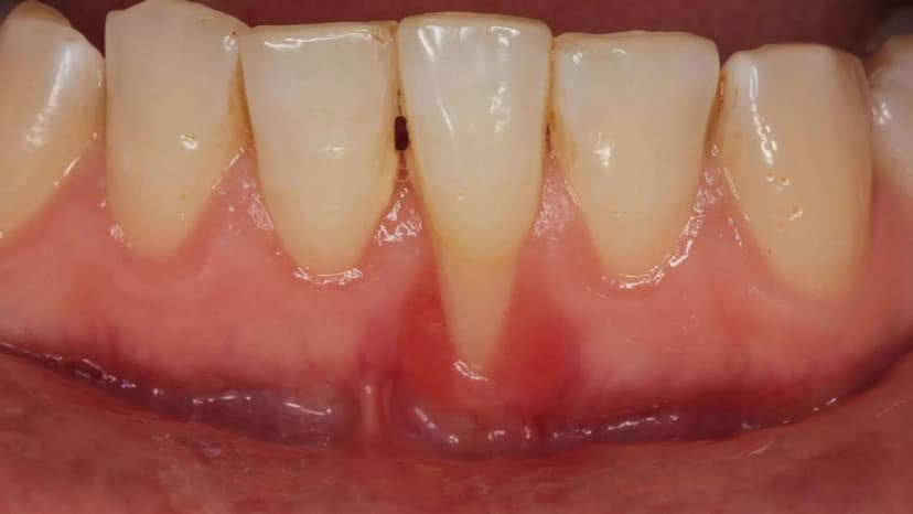 Tụt lợi là gì? Điều trị và phòng ngừa như thế nào?