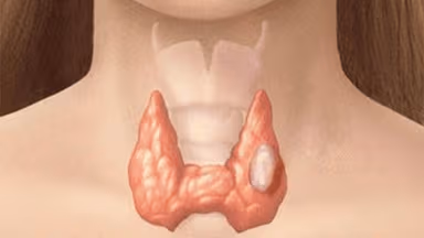 U tuyến giáp có thật sự đáng sợ?
