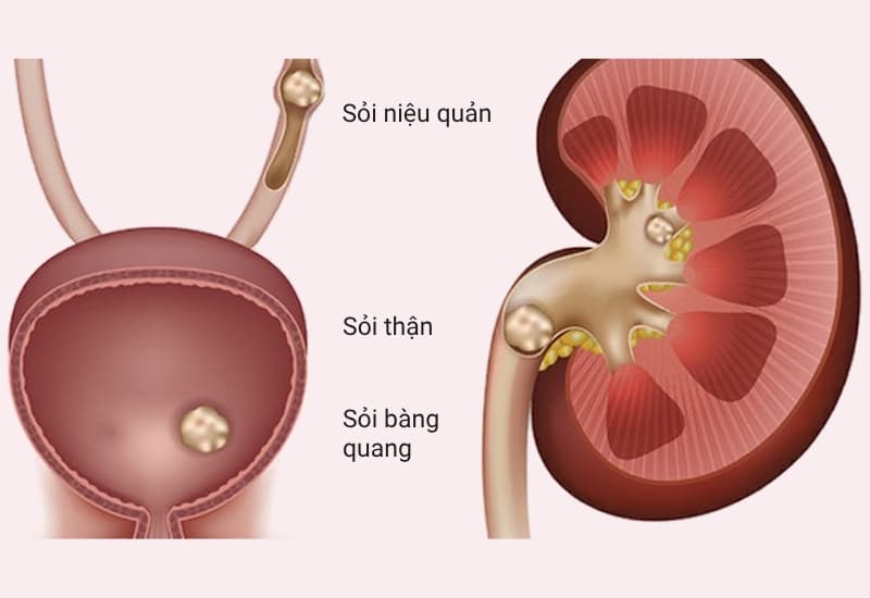 Biến chứng sỏi niệu quản có thể ảnh hưởng đến đường tiết niệu và chức năng thận nếu tắc nghẽn kéo dài