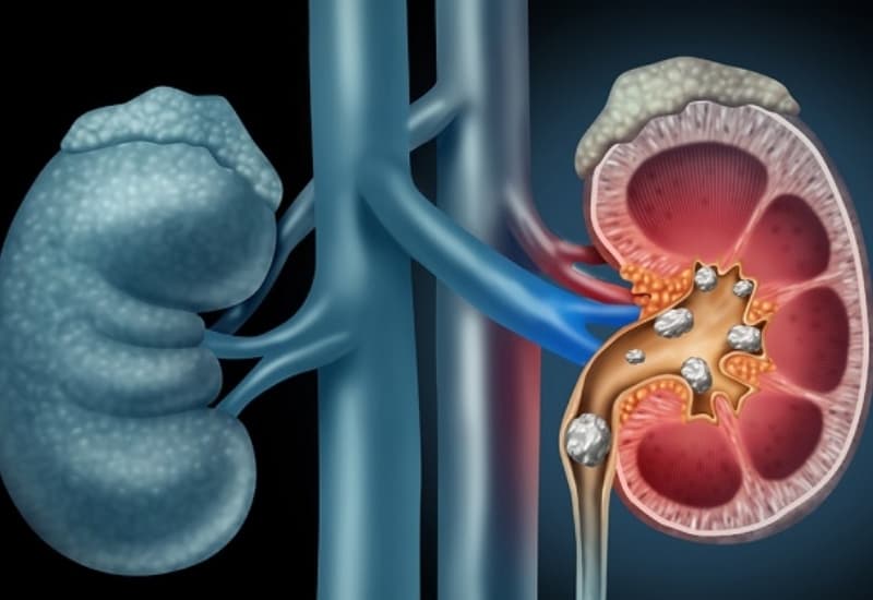 Vị trí và đặc điểm sỏi là những yếu tố ảnh hưởng đến khả năng sỏi thận 6mm tự ra ngoài