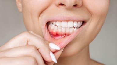 Viêm lợi: Dấu hiệu nhận biết, chẩn đoán và điều trị như thế nào?
