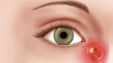 Viêm túi lệ là gì? Dấu hiệu, cách điều trị và phòng ngừa ra sao?