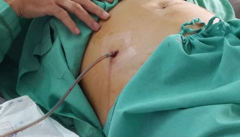 Dẫn lưu túi mật qua da có thể được chỉ định để giảm áp lực trong túi mật và kiểm soát nhiễm trùng