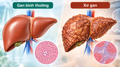 Xơ gan: Nguyên nhân, dấu hiệu, biến chứng và điều trị