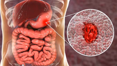 Biến chứng xuất huyết tiêu hóa trên: Dấu hiệu nguy hiểm và cách xử trí