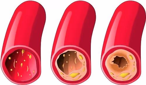Triệu chứng cảnh báo động mạch tắc nghẽn