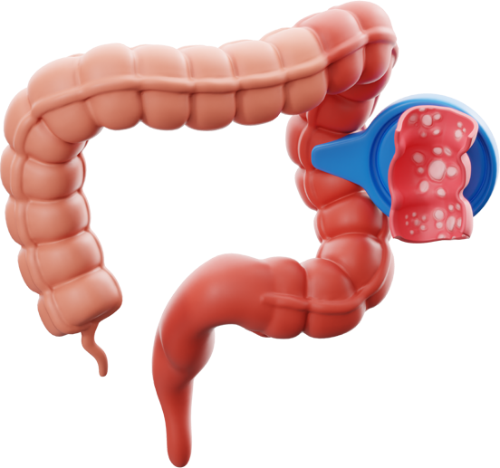 Minh họa đầy hơi táo bón