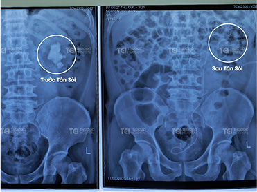 Phim chụp Chú Nguyễn Hữu Bảo