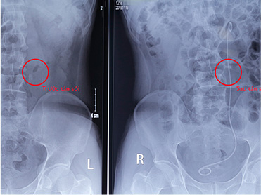 Phim chụp Anh Vũ Văn Dũng