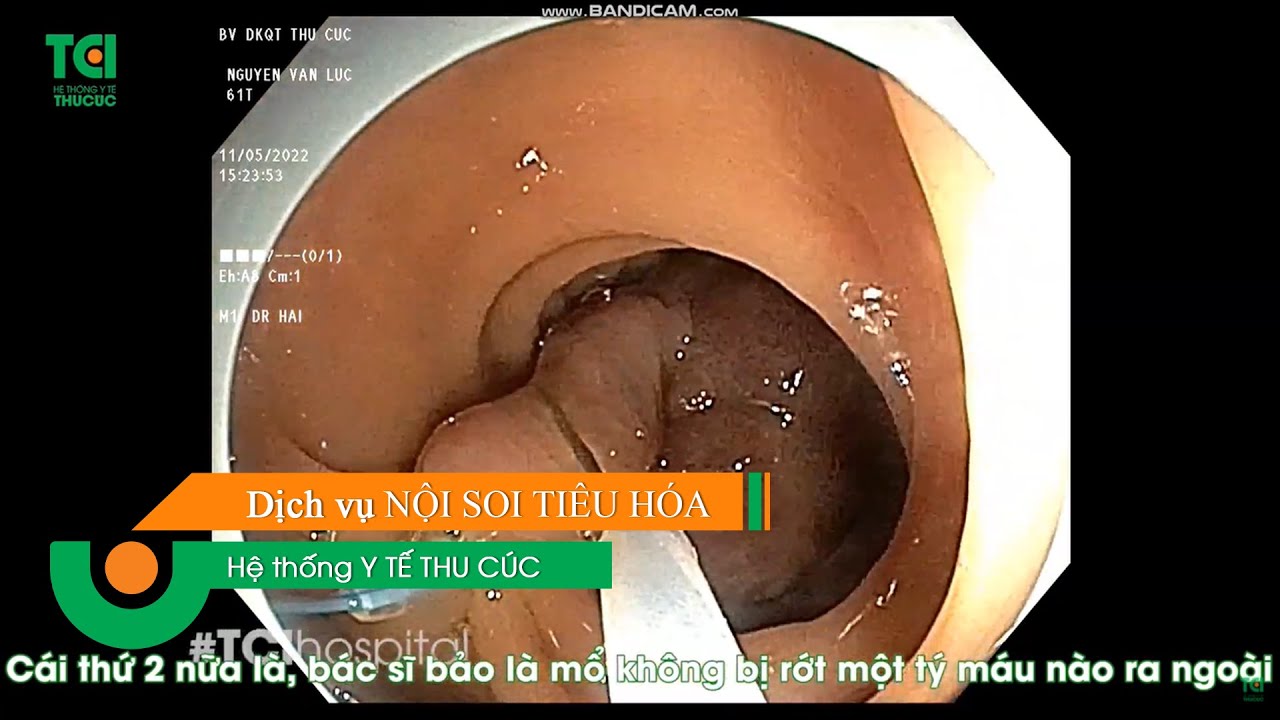 Loại bỏ 9 polyp lớn tại đại tràng chỉ trong 1 ngày