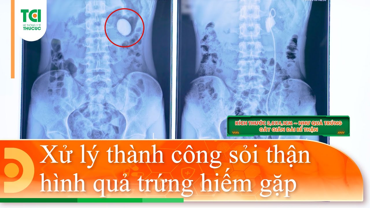 Kỹ thuật cao xử lý thành công sỏi thận hình quả trứng hiếm gặp