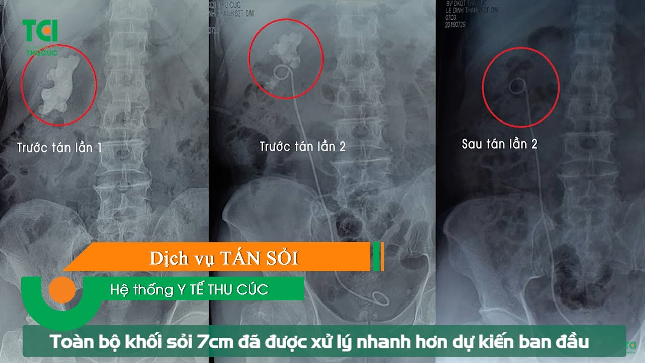 😱Chữa Sỏi Thận 7cm To Như “Củ Gừng” bằng 1 đường hầm siêu nhỏ