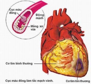 Bệnh tim thiếu máu hay còn gọi là bệnh thiếu máu cơ tim đã và đang là nỗi lo của rất nhiều người.