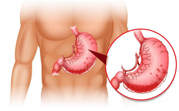 nguyên nhân bệnh tiêu hóa ở người cao tuổi