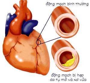 Xơ vữa động mạch và bệnh động mạch vành là những bệnh lí tim mạch gây nguy cơ tử vong cao ở người cao tuổi.