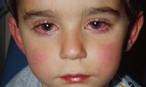 Đau mắt đỏ là căn bệnh rất dễ lây lan đối với trẻ em
