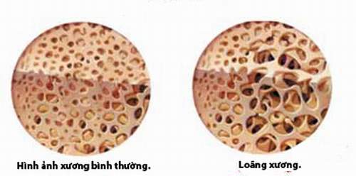 Khám bệnh loãng xương ở đâu Khám bệnh loãng xương ở đâu