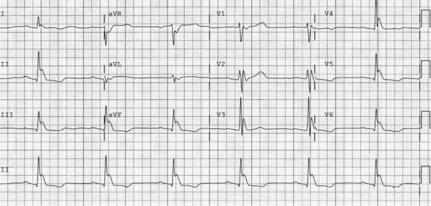 Điện tâm đồ là phương pháp giúp chẩn đoán chính xác bệnh rối loạn nhịp tim