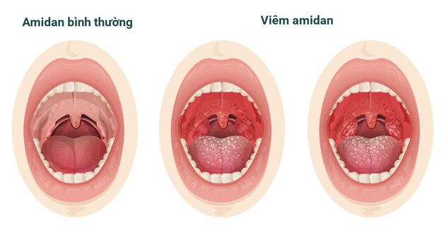 Bệnh lý viêm Amidan được xác định khi Amidan nhiễm trùng, sưng, phù nề.