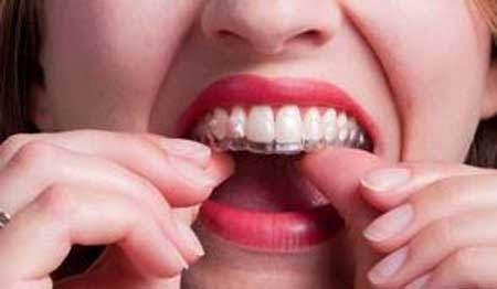 Niềng răng invisalign có đau không?123