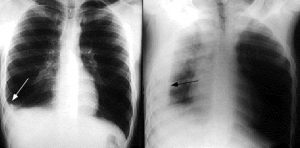 Hình ảnh Xquang bệnh nhân tràn dịch màng phổi phải