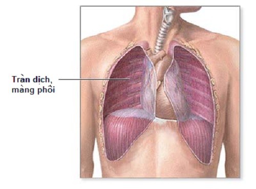 Hình ảnh giải phẫu về tràn dịch màng phổi