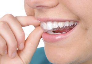 Niềng răng là giải pháp mang lại hiệu quả thẩm mỹ cao, bền đẹp cho hàm răng
