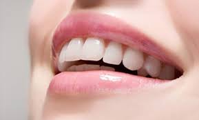 Niềng răng giúp lấy lại vẻ đẹp thẩm mỹ cho hàm răng