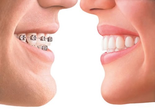 Niềng răng là giải pháp chỉnh nha hiện đại giúp khắc phục các vấn đề, mang lại vẻ đẹp thẩm mỹ cho hàm răng
