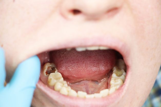 Các bệnh răng miệng ở trẻ em: sâu răng