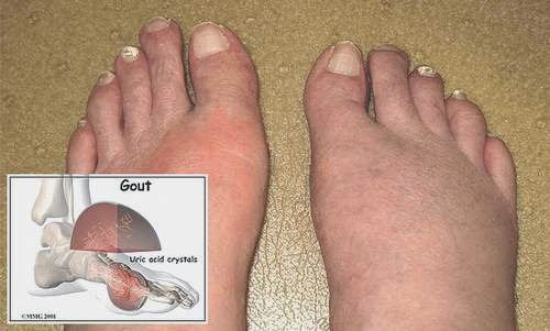 co-che-benh-sinh-benh-gout2