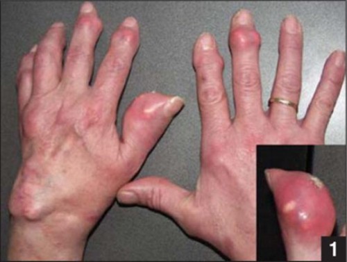 co-che-benh-sinh-benh-gout3
