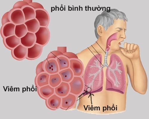 Viêm phổi là bệnh có thể gặp ở mọi lứa tuổi với nhiều triệu chứng phiền toái