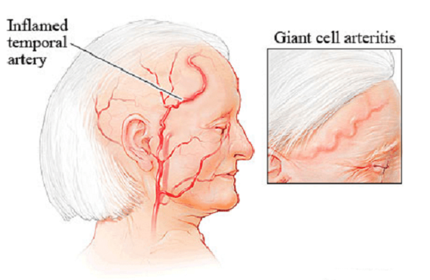 Viêm động mạch thái dương gây bệnh đau đầu ở người già