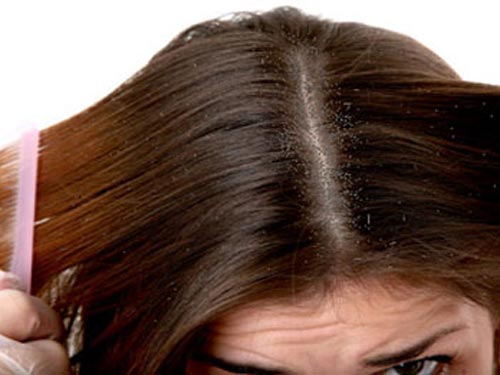 Bệnh vẩy nến da đầu gây nhiều phiền toái cho người bệnh.