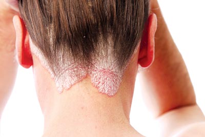 Bệnh vẩy nến da đầu là một trong những bệnh về da mạn tính, thuộc thể vẩy nến thông thường, tiến triển từng đợt, dai dẳng.