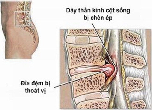 dau-than-kinh-cot-song2