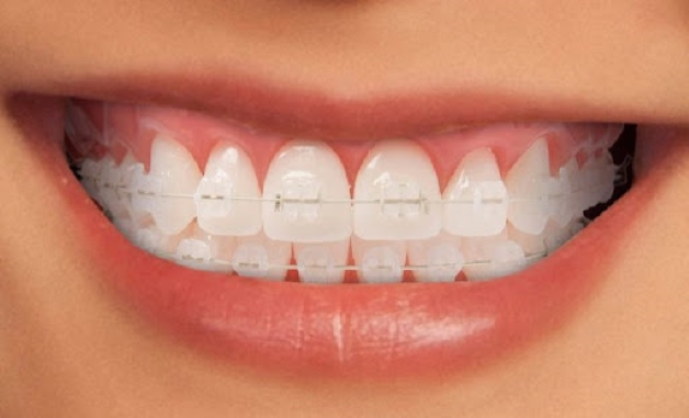 niềng răng với mắc cài sứ