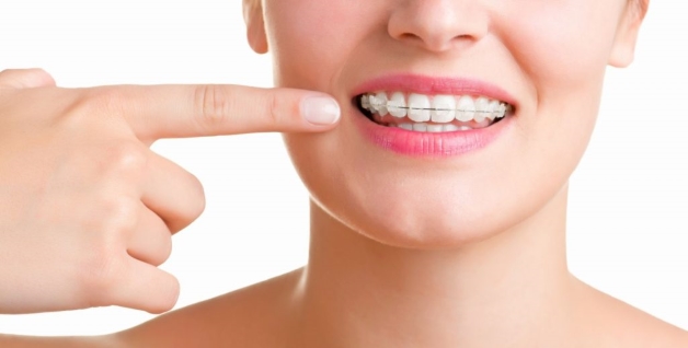 niềng răng với mắc cài
