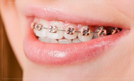 Niềng răng đòi hỏi bác sĩ thực hiện phải có trình độ chuyên môn cao. Các khí cụ hỗ trợ niềng răng phải là những khí cụ nha khoa tốt nhất.
