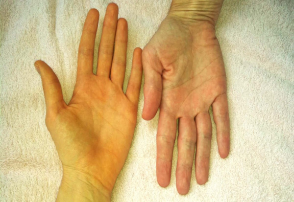 con đường lây nhiễm bệnh viêm gan B