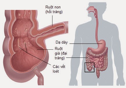 Bệnh Crohn là gì? Kiến thức về Crohn