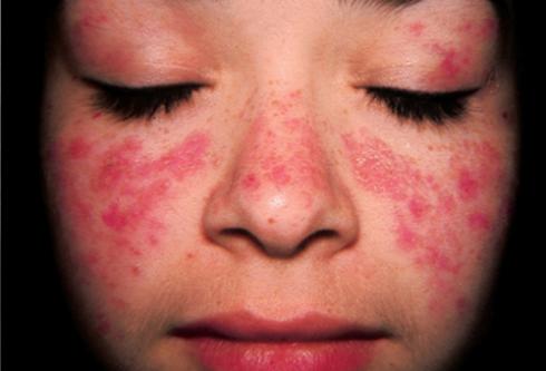 Bệnh lupus ban đỏ có di truyền không2