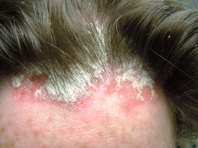 Nguyên nhân của bệnh nấm da đầu