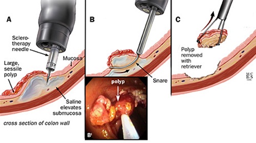 Phẫu thuật mổ cắt polyp đại tràng qua nội soi.