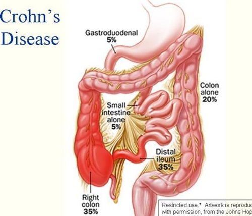 Bệnh Crohn gây loét ruột non và đại tràng. bệnh crohn