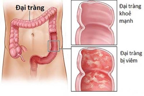 Đau 2 Bên Hông Bụng: Nguyên Nhân và Giải Pháp