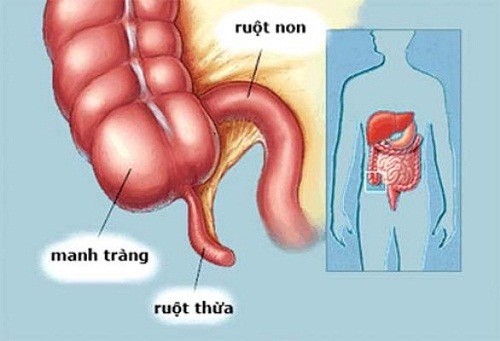 Đau bụng viêm ruột thừa là tình trạng cấp cứu ngoại khoa phổ biến gặp nhất